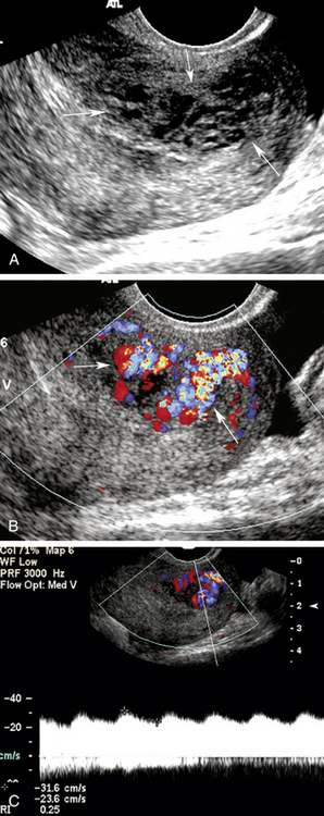 Duplex Ultrasound Evaluation Of The Uterus And Ovaries Radiology Key 