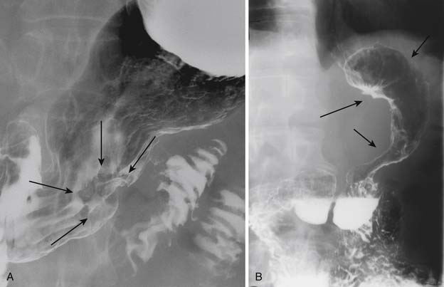 gastric cancer x ray oxiuri alaptare