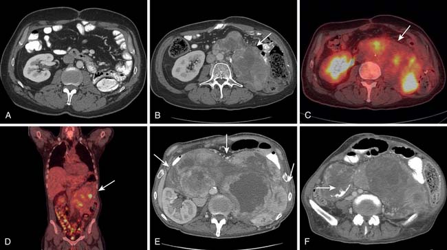 Primary Retroperitoneal Neoplasms Radiology Reference Article | My XXX ...