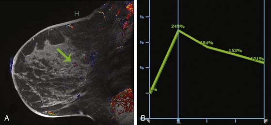 Linear breast measurements: (A) mid-calvicular to nipple, (B)