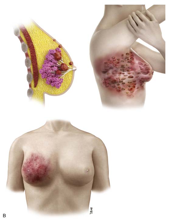 Linear breast measurements: (A) mid-calvicular to nipple, (B