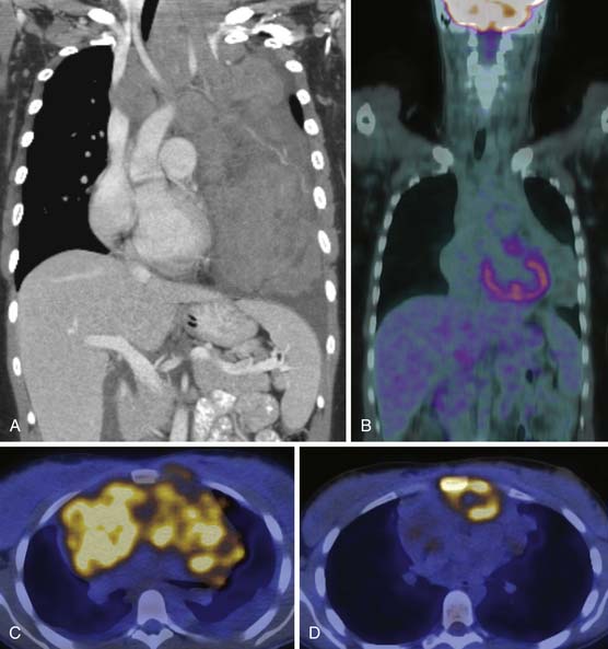 Hematologic Malignancy: The Lymphomas | Radiology Key