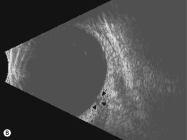 Glaucoma | Radiology Key