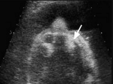 anophthalmia ultrasound