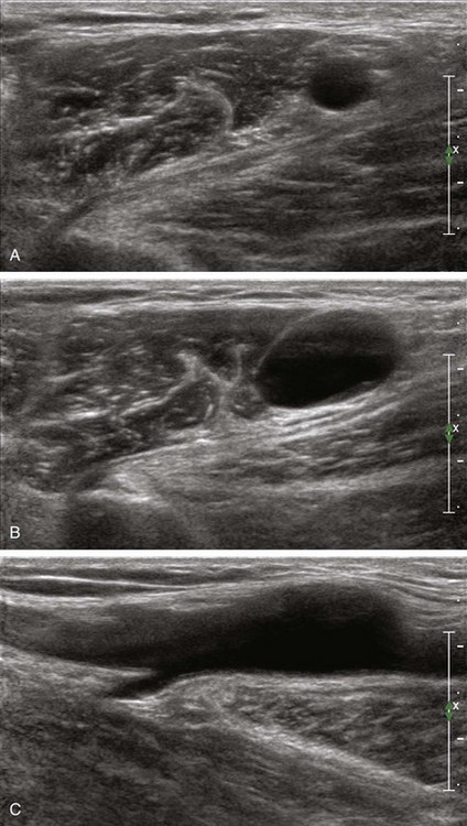 Lymph Nodes Radiology Key