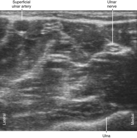 Ulnar Nerve Block | Radiology Key