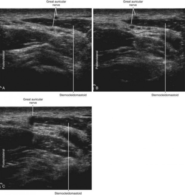 Sural Nerve Block | Radiology Key