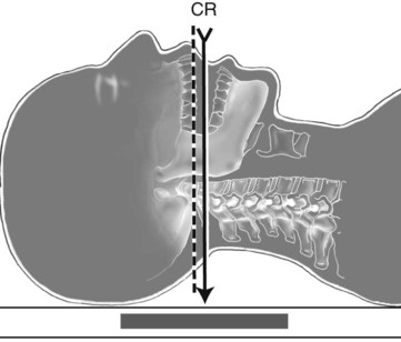 Spine | Radiology Key