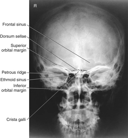 Skull Facial Bones And Paranasal Sinuses Radiology Key