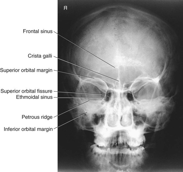 Skull Facial Bones And Paranasal Sinuses Radiology Key