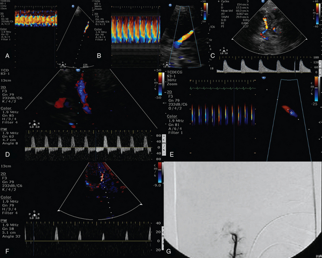 Transcranial Doppler In The Diagnosis Of Cerebral Circulatory Arrest ...