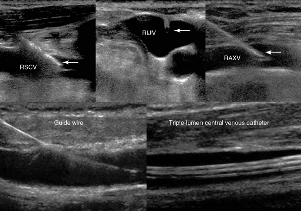 Ultrasound-guided Vascular Access: Trends And Perspectives | Radiology Key