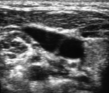 Pediatric ultrasound-guided vascular access | Radiology Key