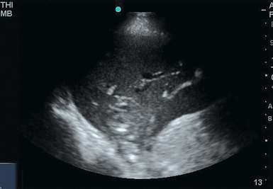 Lung Ultrasound: The Basics | Radiology Key