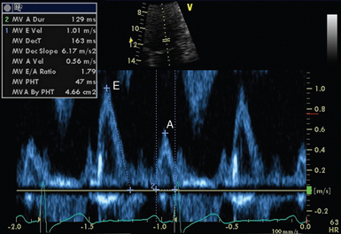 Transthoracic echocardiography: An overview | Radiology Key