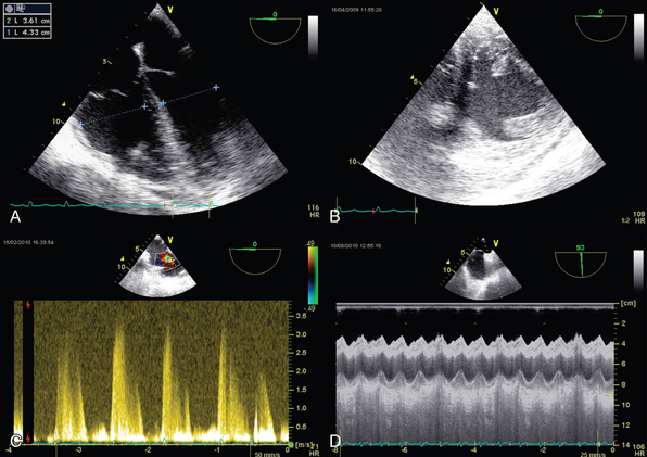 Evaluation of right ventricular function in the intensive care unit by ...