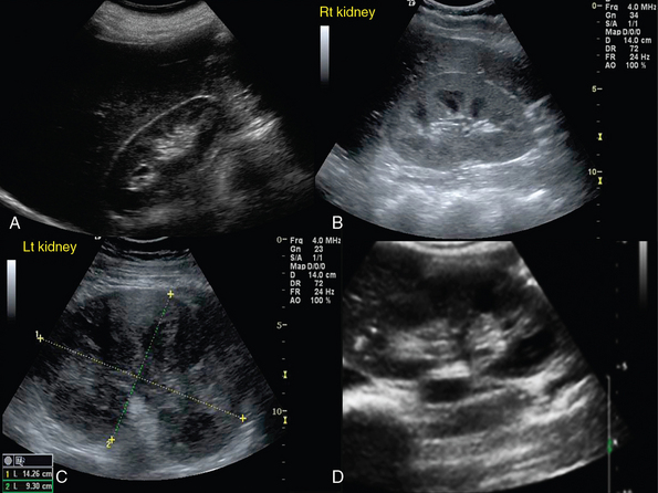 glomerulonephritis ultrasound