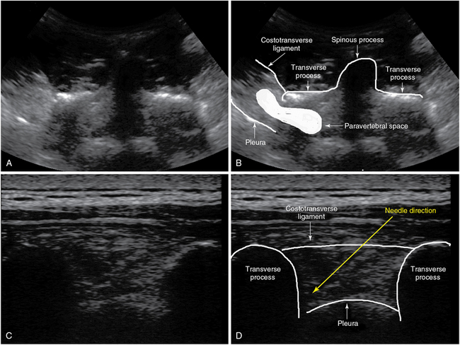 Ultrasound-guided regional anesthesia in the intensive care unit ...