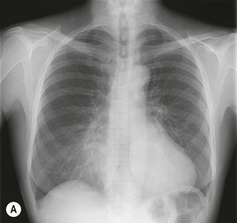 The Chest Wall, Pleura, Diaphragm and Intervention | Radiology Key