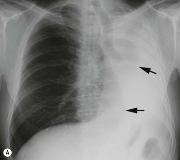 Pulmonary Lobar Collapse | Radiology Key