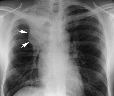 Pulmonary Lobar Collapse | Radiology Key