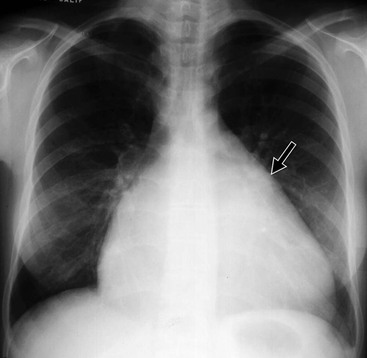 Non-Ischaemic Acquired Heart Disease | Radiology Key