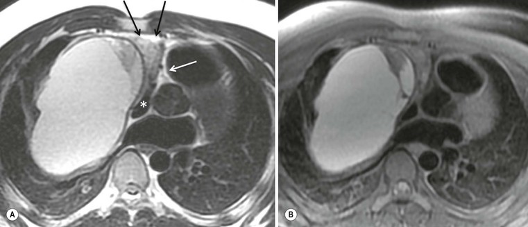 non-ischaemic-acquired-heart-disease-radiology-key