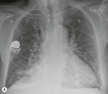 Pulmonary Circulation and Pulmonary Thromboembolism | Radiology Key