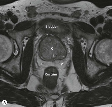 prostate gland anatomy mri