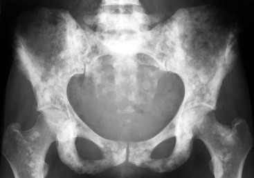 bone pelvis metastases sclerotic multiple breast tumours radiograph showing ap figure radiology radiologykey