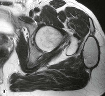 Soft Tissue Tumours | Radiology Key