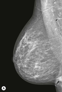 Breast x-ray  definition of Breast x-ray by Medical dictionary