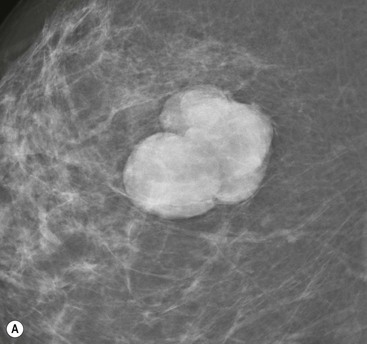 Breast Mass  Radiology Key