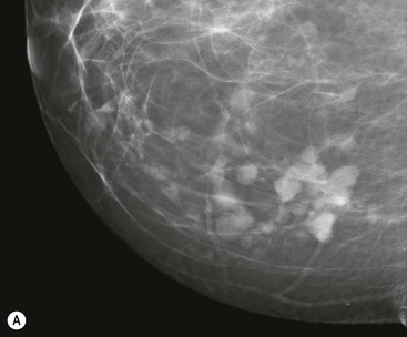 The Breast  Radiology Key