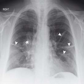 Bronchiectasis X Ray Tram Track