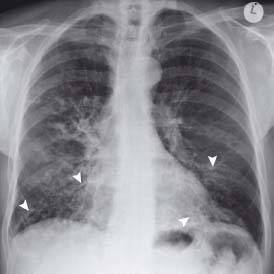 bronchiectasis x ray tram track