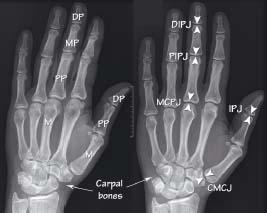 Extremity XR anatomy I: upper limb | Radiology Key