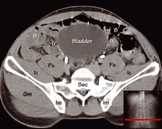 Abdominal CT anatomy | Radiology Key