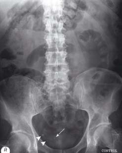 ivu kub ct pelvis stone calcification calculus ureteric right vuj radiology small there junction radiologykey