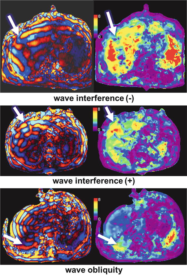Liver Resonance Elastography Technique Radiology Key