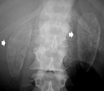 nephrolithiasis x ray