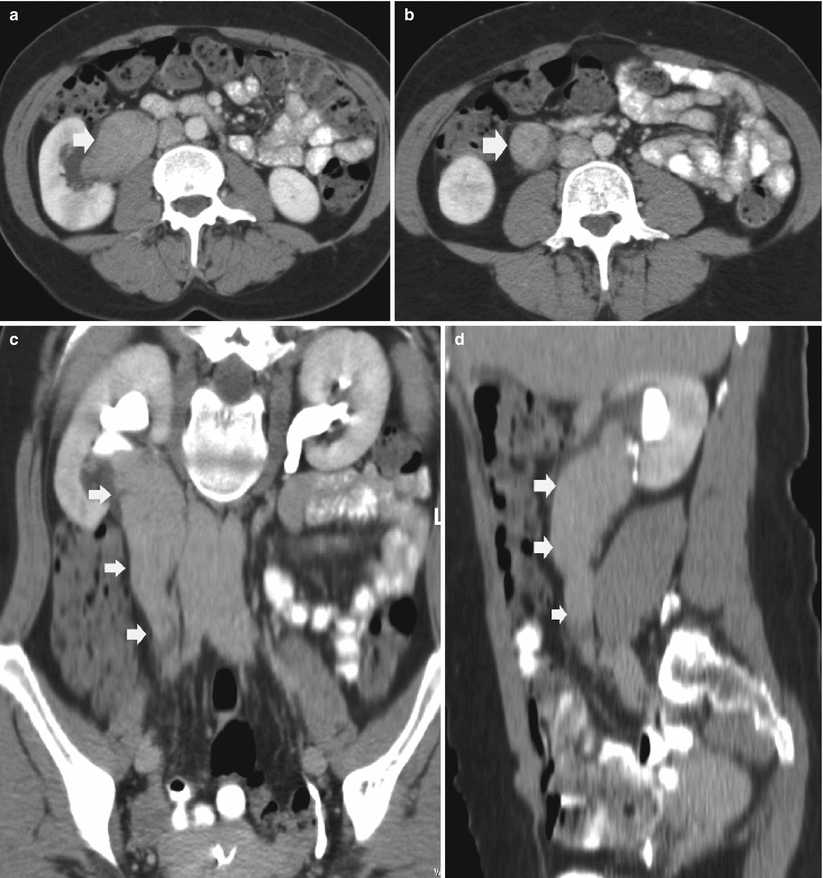 Urinary Tract Tumors | Radiology Key