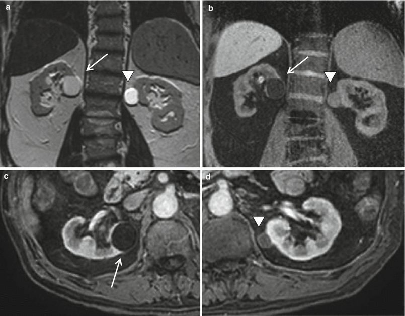 Kidney Mri