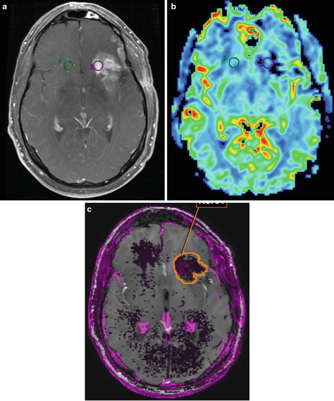 MR Perfusion Imaging: ASL, T2*-Weighted DSC, and T1-Weighted DCE ...