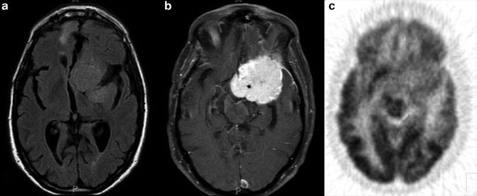 Imaging Metabolic And Molecular Functions In Brain Tumors With Positron ...