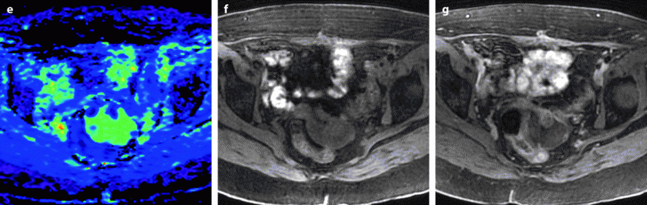 Benign And Malignant Endometrium Radiology Key 