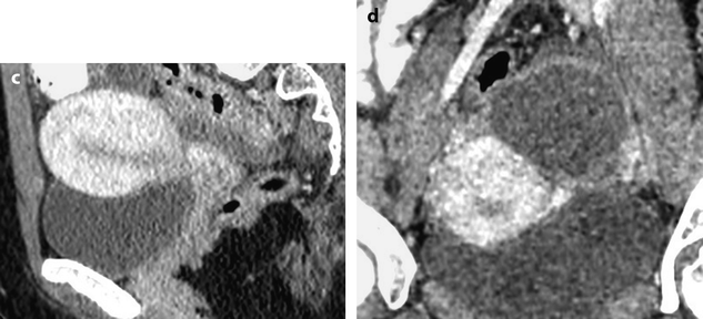 Anatomy Histology And Normal Imaging Of The Endometrium Radiology Key 