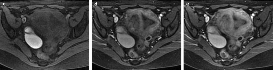 Benign And Malignant Endometrium Radiology Key