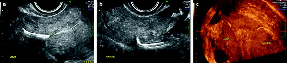 Benign and Malignant Endometrium | Radiology Key