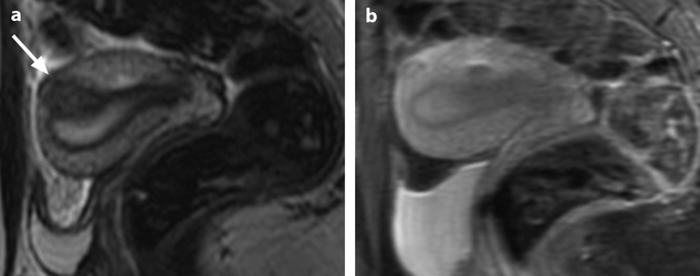 Anatomy and Histology of the Uterus Body | Radiology Key